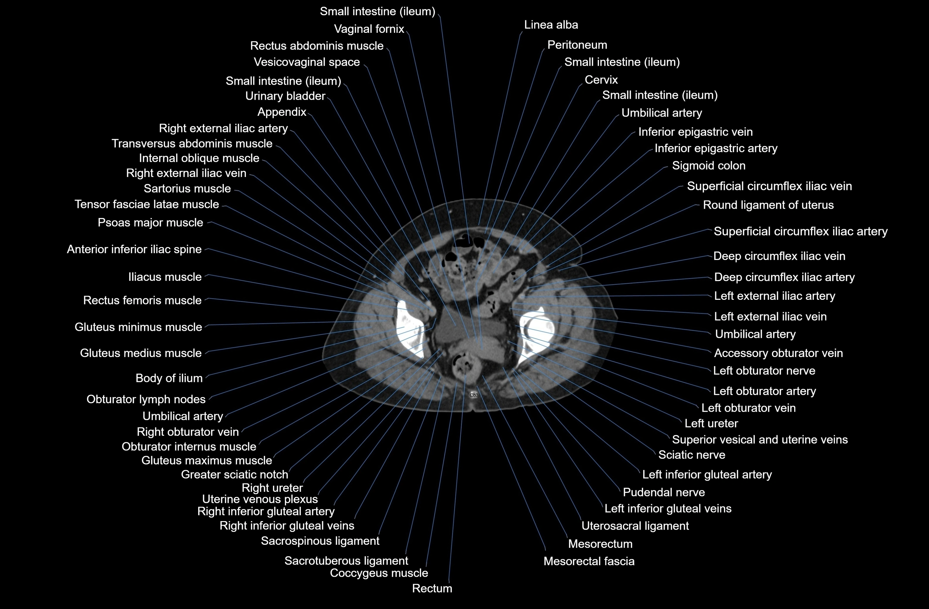 CT Abdomen axial cross sectional anatomy labelled radiology image-00087.webp